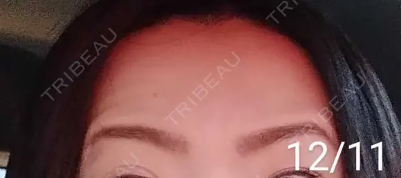 ボトックス（額） 湘南美容クリニック 宇都宮院 DAY 16 メイン用