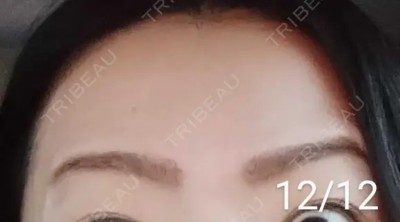 ボトックス（額） 湘南美容クリニック 宇都宮院 DAY 17 メイン用