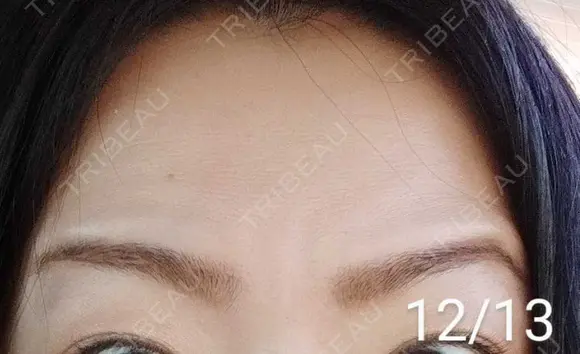 ボトックス（額） 湘南美容クリニック 宇都宮院 AFTER メイン用