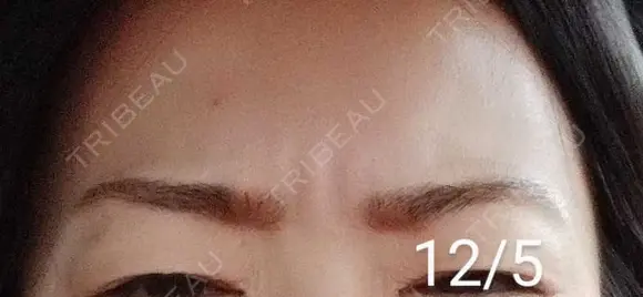 ボトックス（眉間） / その他（肌） 湘南美容クリニック 宇都宮院 DAY 10 メイン用