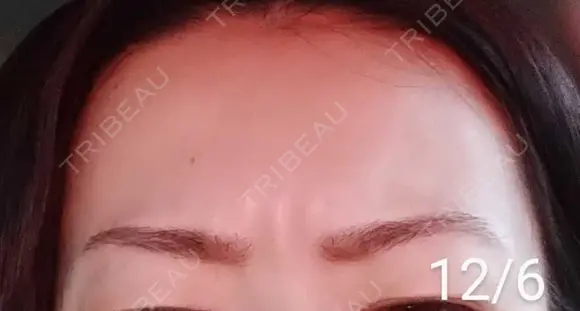 ボトックス（眉間） / その他（肌） 湘南美容クリニック 宇都宮院 DAY 11 メイン用