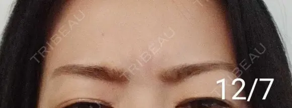 ボトックス（眉間） / その他（肌） 湘南美容クリニック 宇都宮院 DAY 12 メイン用