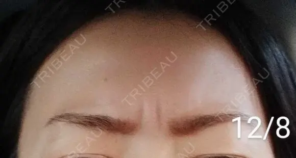 ボトックス（眉間） / その他（肌） 湘南美容クリニック 宇都宮院 DAY 13 メイン用
