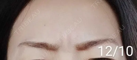 ボトックス（眉間） / その他（肌） 湘南美容クリニック 宇都宮院 DAY 15 メイン用