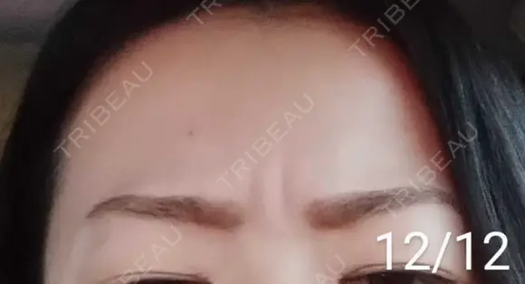 ボトックス（眉間） / その他（肌） 湘南美容クリニック 宇都宮院 DAY 17 メイン用