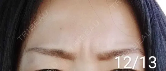 ボトックス（眉間） / その他（肌） 湘南美容クリニック 宇都宮院 AFTER メイン用