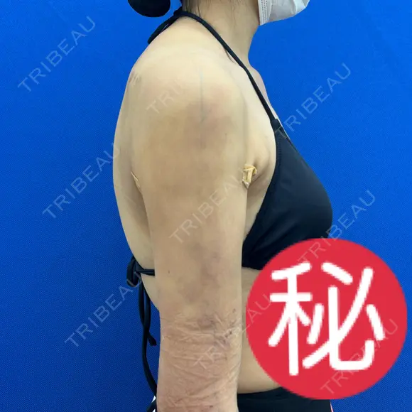 脂肪吸引（二の腕） / 脂肪吸引（背中） / 脂肪吸引（肩） 湘南美容クリニック 京都院 DAY 2 メイン用