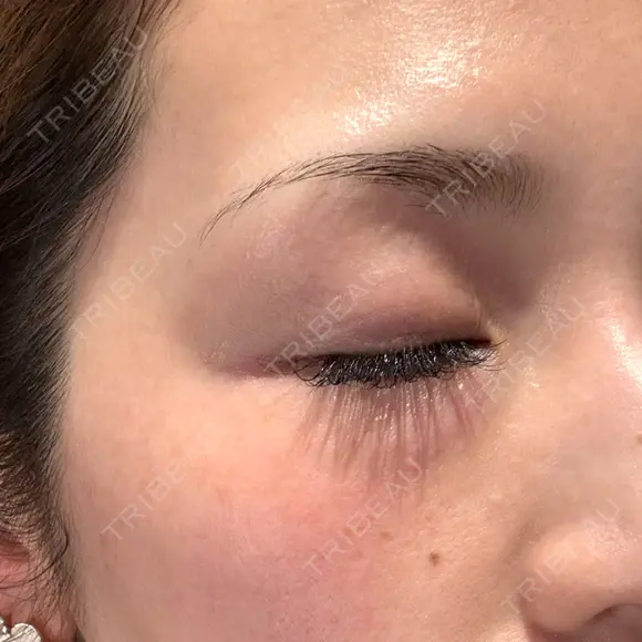 光治療（フォトフェイシャルなど） メディアージュクリニック 青山院 DAY 0 メイン用