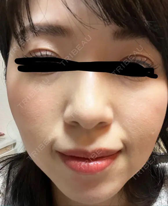 イオン導入 椿クリニック 名古屋院 DAY 10 メイン用