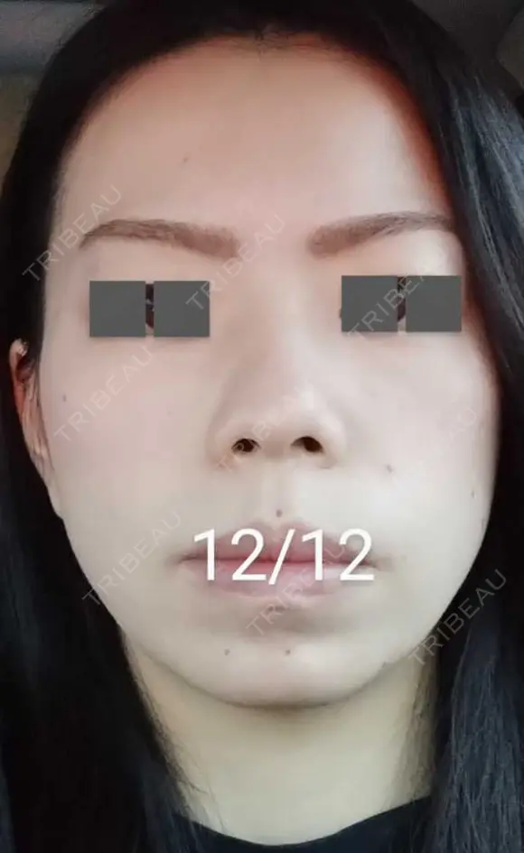 ハイフ（顔） / ハイフ（首） 湘南美容クリニック 宇都宮院 DAY 17 メイン用