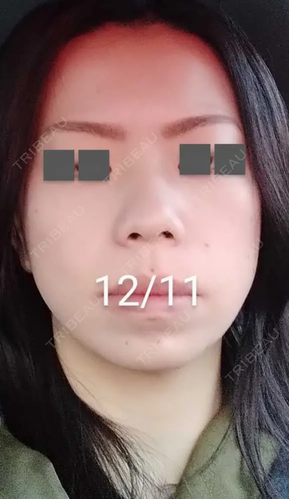 ハイフ（顔） / ハイフ（首） 湘南美容クリニック 宇都宮院 DAY 16 メイン用