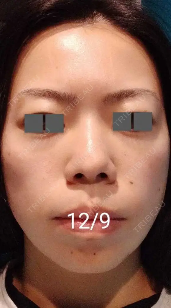 ハイフ（顔） / ハイフ（首） 湘南美容クリニック 宇都宮院 DAY 14 メイン用