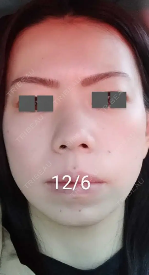 ハイフ（顔） / ハイフ（首） 湘南美容クリニック 宇都宮院 DAY 11 メイン用