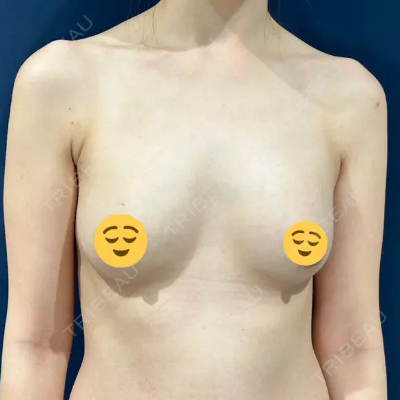 脂肪吸引（脚） / 豊胸（脂肪注入） S.T styleクリニック DAY 8 メイン用