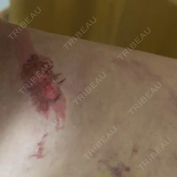 脂肪吸引（脚） / 豊胸（脂肪注入） S.T styleクリニック DAY 8 メイン用