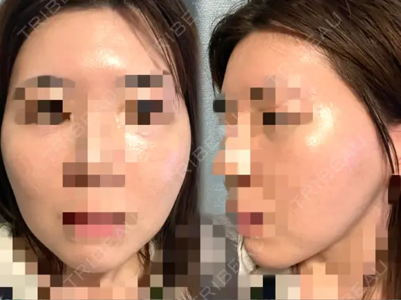 脂肪注入（額） GRACIA clinic 【グラシアクリニック】 DAY 43 メイン用