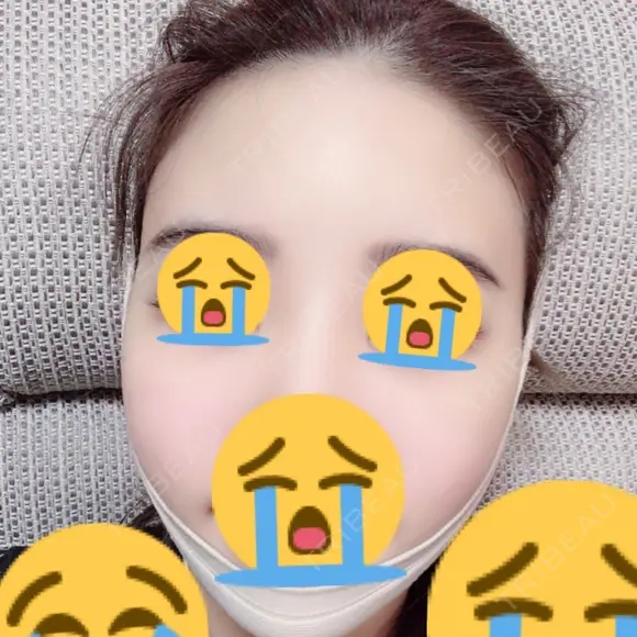 脂肪吸引（顔） / 額を丸く / 脂肪吸引（脚） / こめかみ形成 / 輪郭修正 / 脂肪注入（額） / 脂肪注入（輪郭） フレッシュ整形外科 DAY 25 メイン用