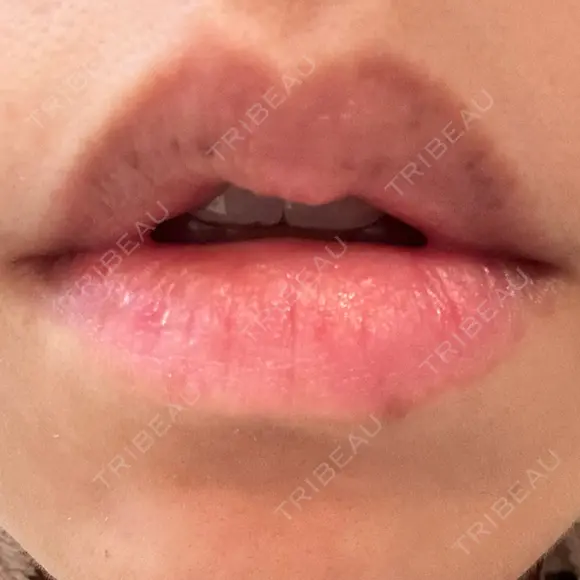 シミ取りレーザー Jスキンクリニック 【J-SKIN clinic】 DAY 7 メイン用