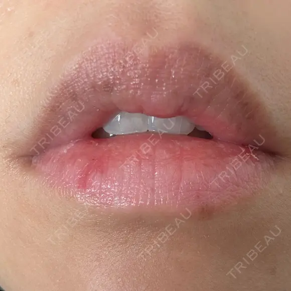 シミ取りレーザー Jスキンクリニック 【J-SKIN clinic】 DAY 9 メイン用