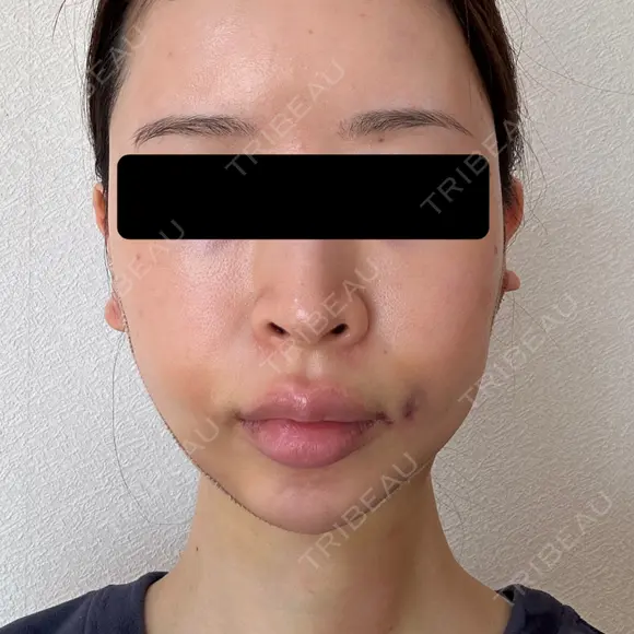 糸リフト / 脂肪吸引（顔） / ヒアルロン酸注入（あご） / ヒアルロン酸注入（こめかみ） BLINC CLINIC （ブリンク クリニック） DAY 2 メイン用