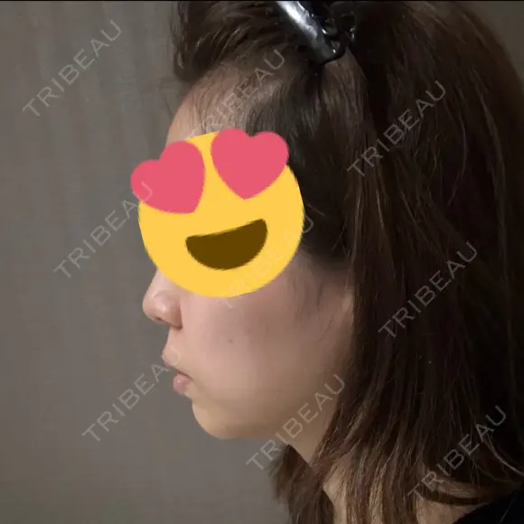 ヒアルロン酸注入（あご） TCB東京中央美容外科 自由が丘院 DAY 3 メイン用