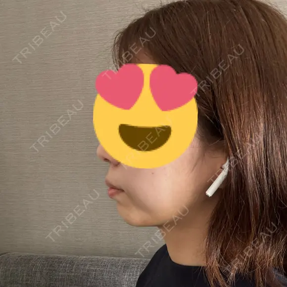 ヒアルロン酸注入（あご） TCB東京中央美容外科 自由が丘院 DAY 4 メイン用