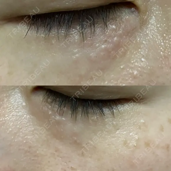 ニードルRF（ポテンツァなど） 表参道スキンクリニック 名古屋院（DAILY SKIN CLINIC提携院） DAY 2 メイン用