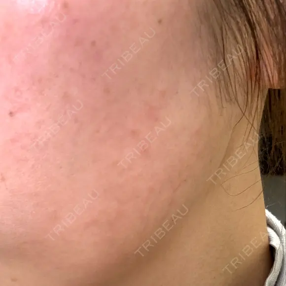 光治療（フォトフェイシャルなど） メディアージュクリニック 青山院 AFTER メイン用