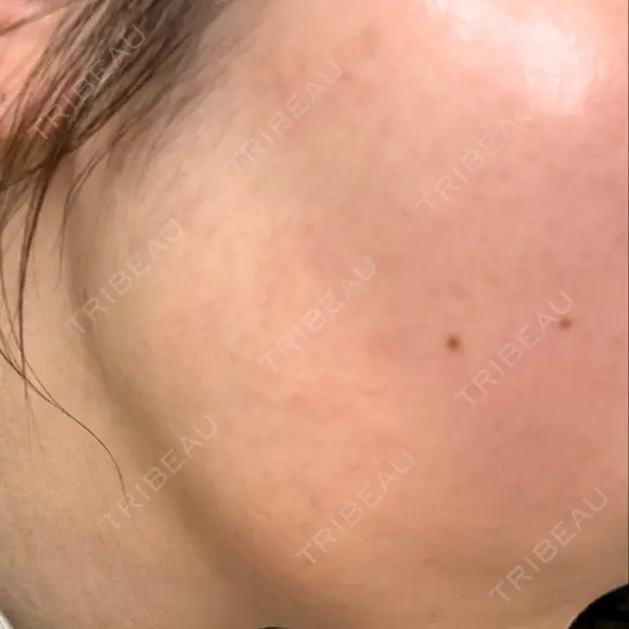 光治療（フォトフェイシャルなど） メディアージュクリニック 青山院 DAY 3 メイン用