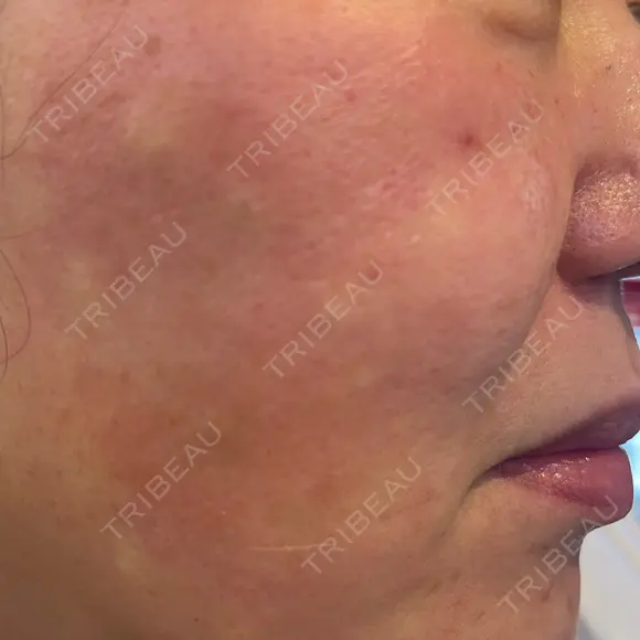 ポテンツァ ドクタープチ美容クリニック -江南店 DAY 0 メイン用