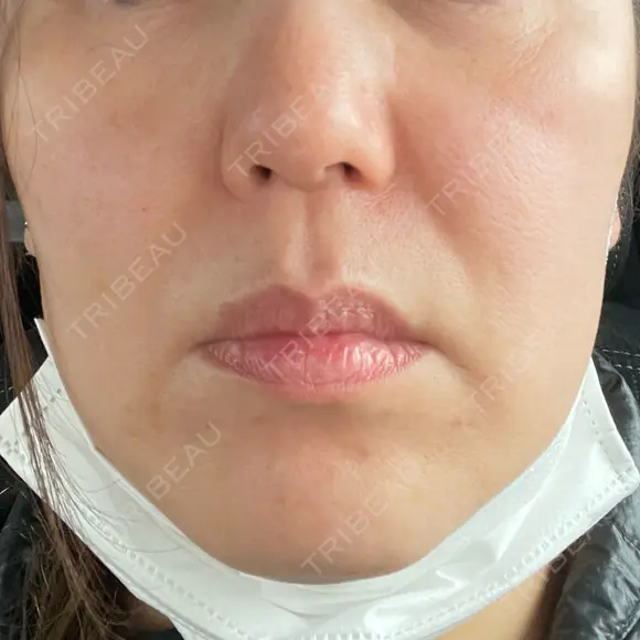 ポテンツァ ドクタープチ美容クリニック -江南店 AFTER メイン用