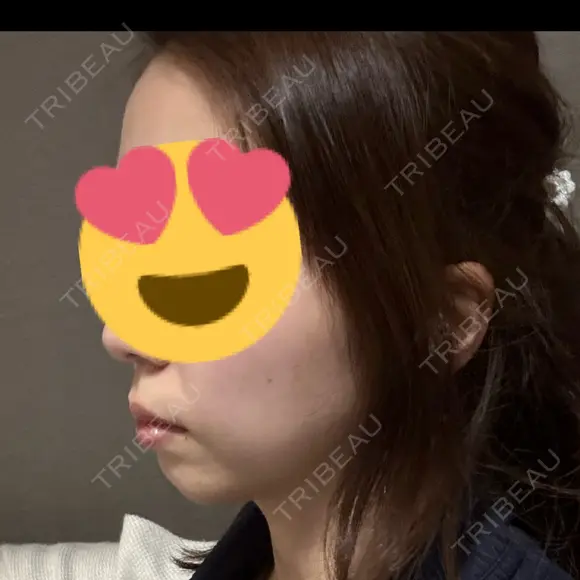 ヒアルロン酸注入（あご） TCB東京中央美容外科 自由が丘院 DAY 6 メイン用