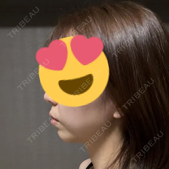 ヒアルロン酸注入（あご） TCB東京中央美容外科 自由が丘院 AFTER メイン用