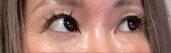 下まぶたの脂肪取り Brandnew Beauty Clinic DAY 8 メイン用