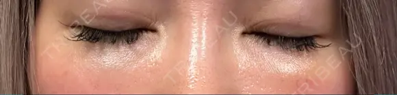 下まぶたの脂肪取り Brandnew Beauty Clinic DAY 8 メイン用