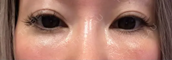 下まぶたの脂肪取り Brandnew Beauty Clinic DAY 8 メイン用