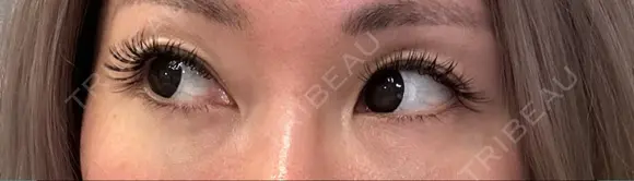 下まぶたの脂肪取り Brandnew Beauty Clinic DAY 13 メイン用