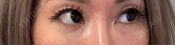 下まぶたの脂肪取り Brandnew Beauty Clinic DAY 13 メイン用