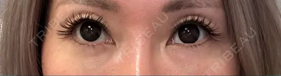 下まぶたの脂肪取り Brandnew Beauty Clinic DAY 13 メイン用