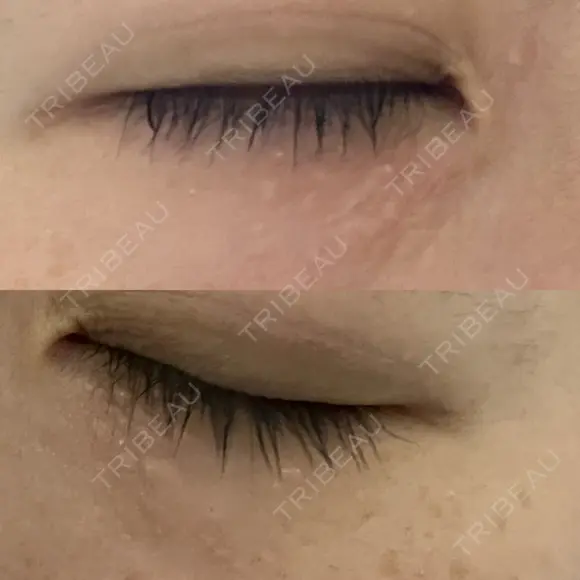 ニードルRF（ポテンツァなど） 表参道スキンクリニック 名古屋院（DAILY SKIN CLINIC提携院） DAY 3 メイン用