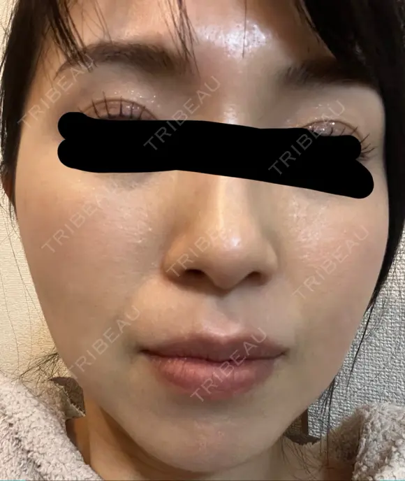 イオン導入 椿クリニック 名古屋院 DAY 14 メイン用