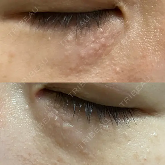 ニードルRF（ポテンツァなど） 表参道スキンクリニック 名古屋院（DAILY SKIN CLINIC提携院） DAY 4 メイン用