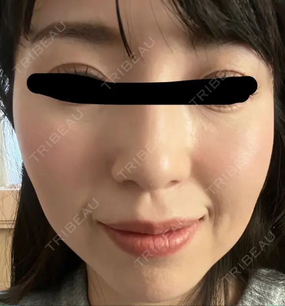 イオン導入 椿クリニック 名古屋院 AFTER メイン用