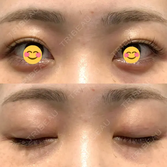 二重埋没 オーキッド美容クリニック東京御徒町 AFTER メイン用