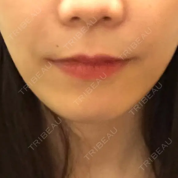 ヒアルロン酸注入（鼻翼基部） KAGA CLINIC DAY 0 メイン用