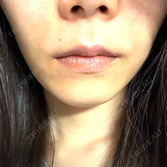 ヒアルロン酸注入（鼻翼基部） KAGA CLINIC DAY 1 メイン用