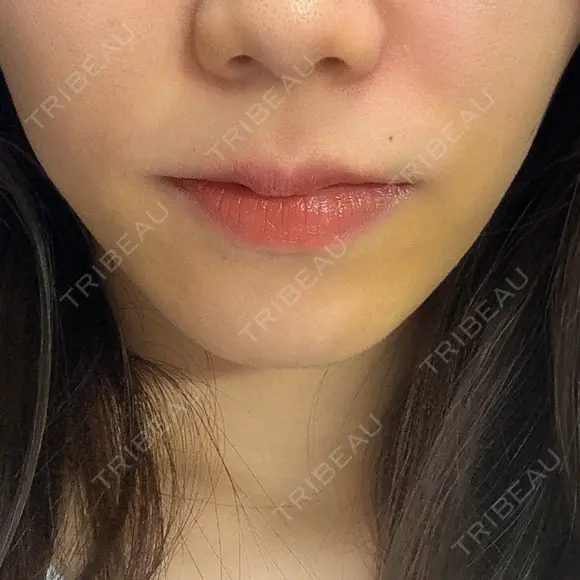 ヒアルロン酸注入（鼻翼基部） KAGA CLINIC DAY 4 メイン用