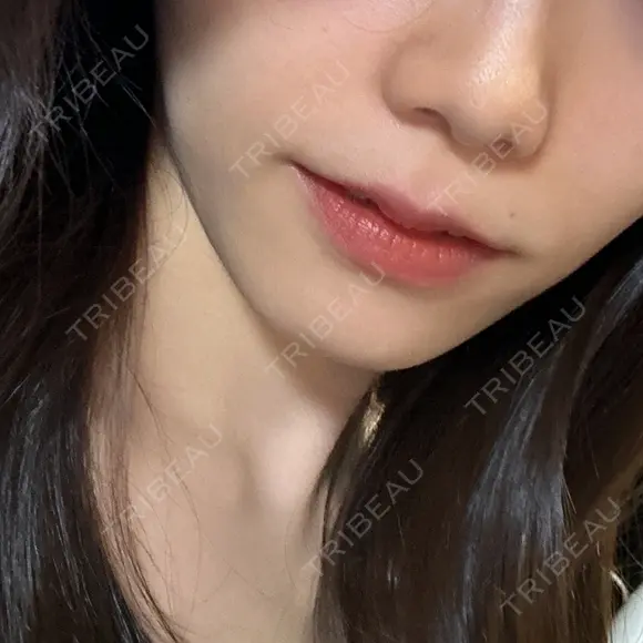 ヒアルロン酸注入（鼻翼基部） KAGA CLINIC AFTER メイン用