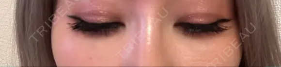下まぶたの脂肪取り Brandnew Beauty Clinic DAY 15 メイン用