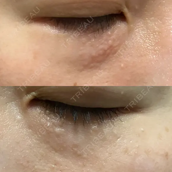 ニードルRF（ポテンツァなど） 表参道スキンクリニック 名古屋院（DAILY SKIN CLINIC提携院） DAY 5 メイン用